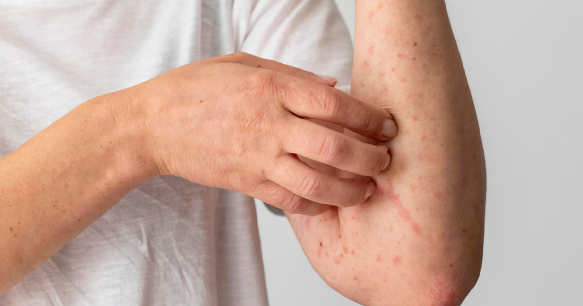 Онищенко прокомментировал ситуацию с оспой обез...