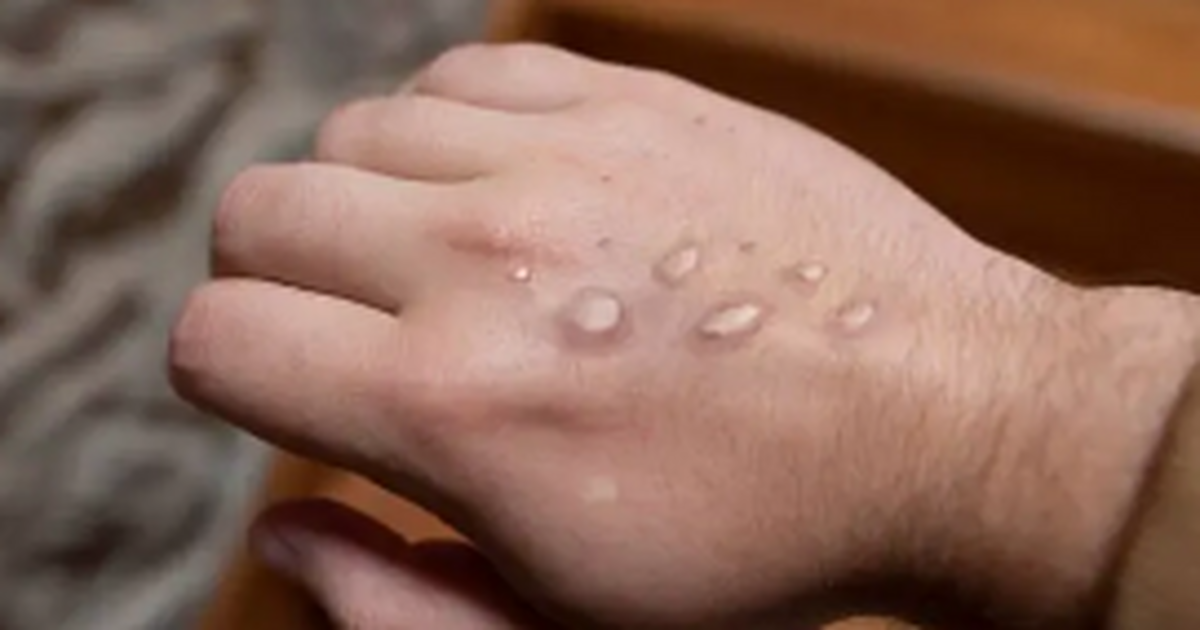 Самарцам рассказали, как распознать оспу обезьян на ранней стадии Инкубационный период инфекции составляет от 6 д...