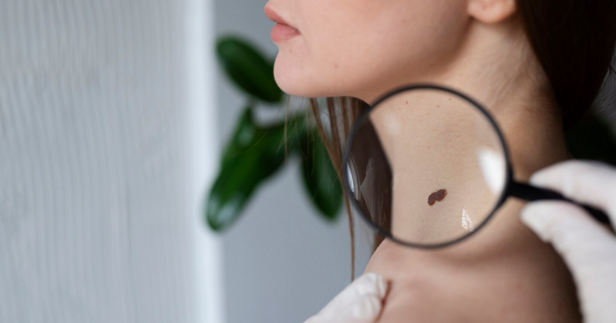 Первые пациенты с меланомой получат отечественн...