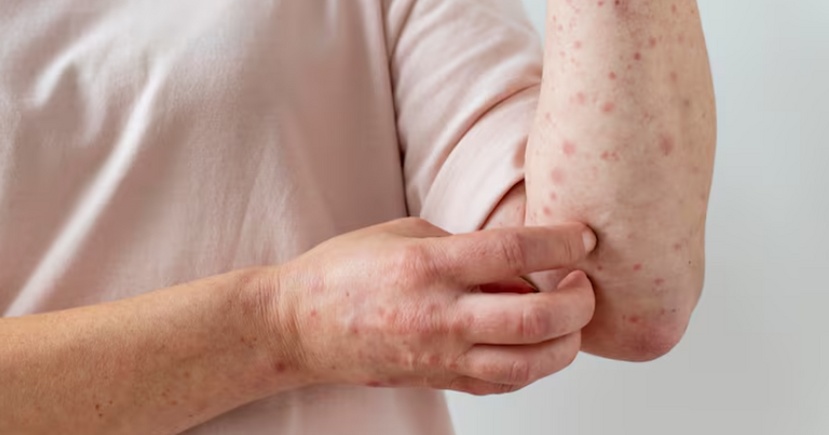 В России отложили запуск вакцинации от ветрянки до 2031 года В России сдвинули сроки включения ряда прививок...