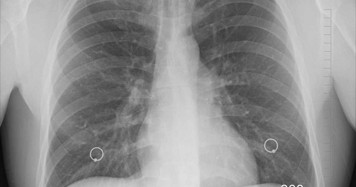 Терапия основана на модифицированном вирусе AAV6.2