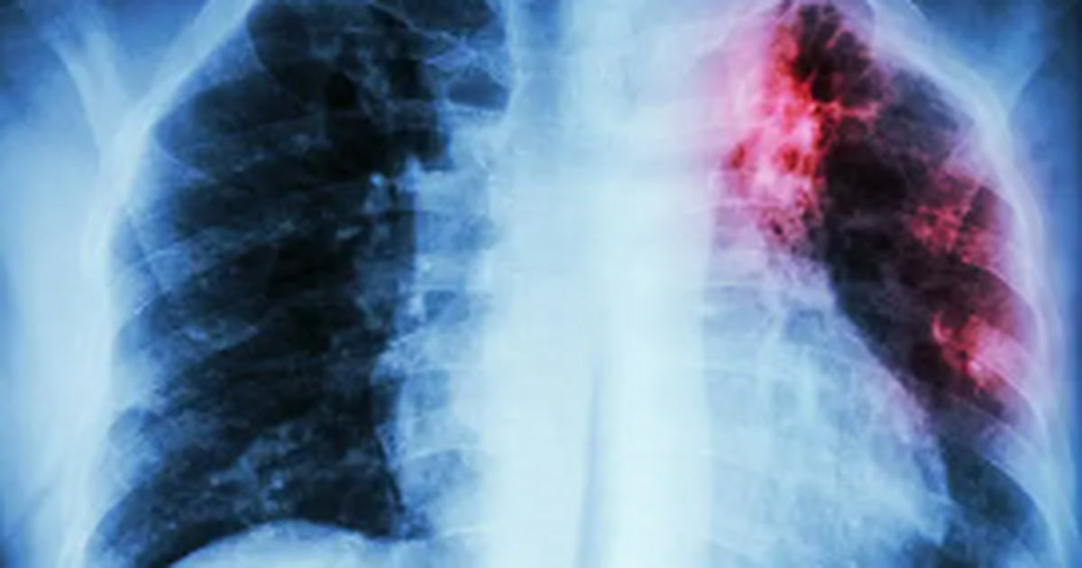 Самарский специалист рассказала, как защититься от туберкулёза Туберкулёз — это заболевание, которое нередко п...