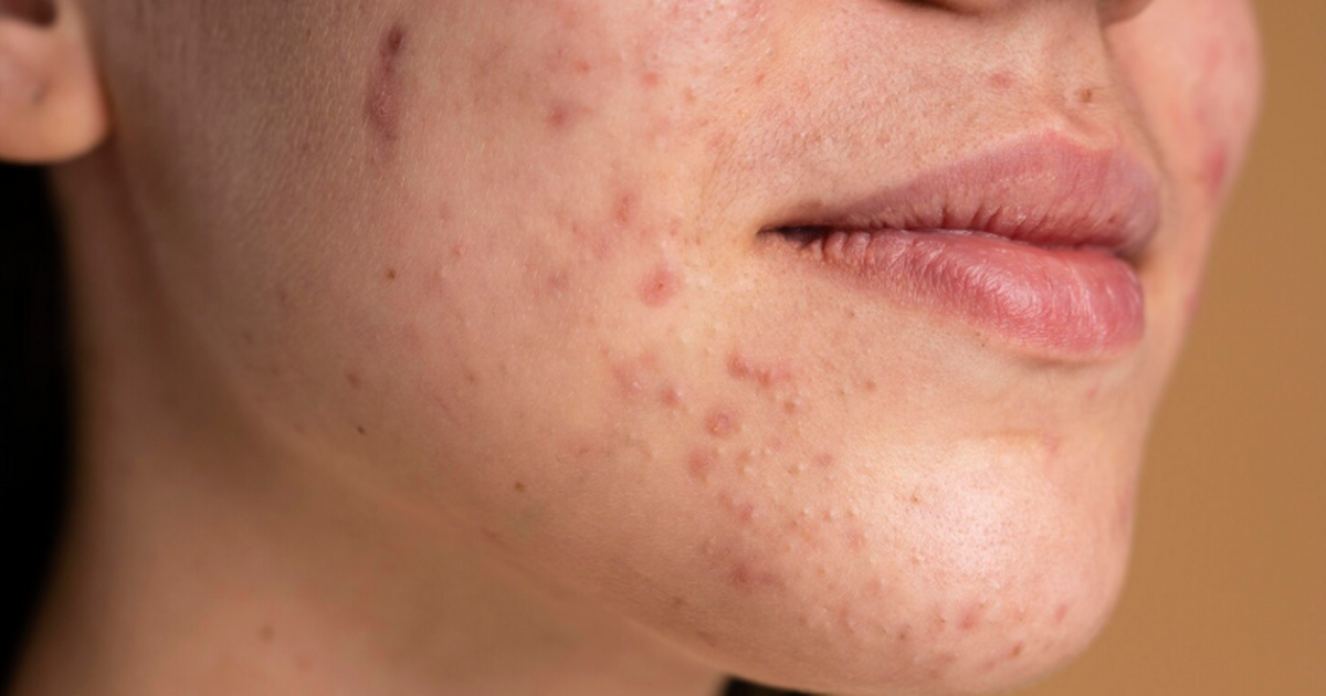 Исследование PNAS показало, что псориазоподобно...