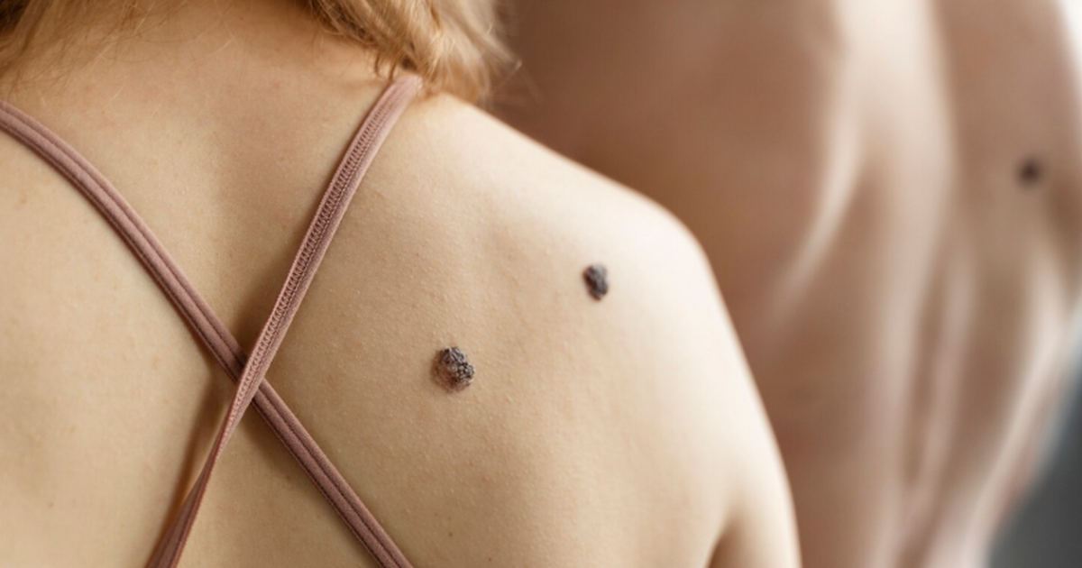 Обнаружена новая генетическая причина стойких плоских бородавок у людей Исследование показало, что мутация гена ITGAL н...