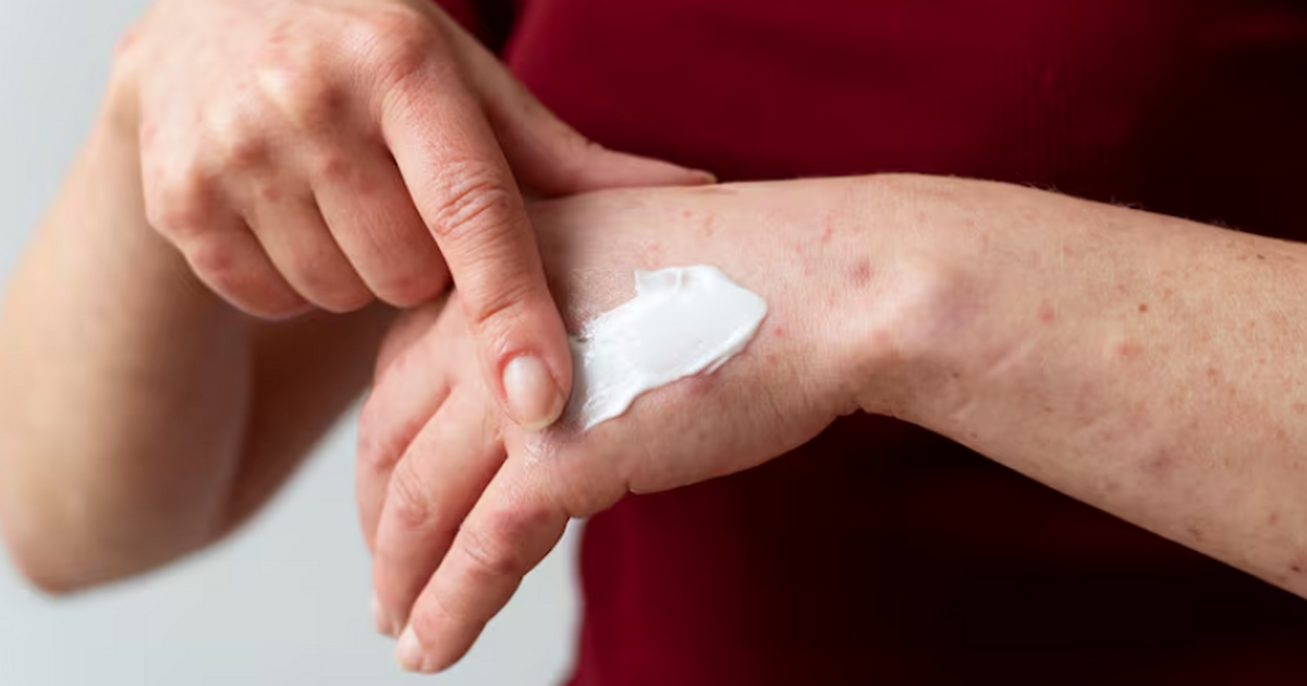 УрФУ: мазь на ланолине с экстрактами трутовиков ускоряет заживление ожогов Биологи Уральского федерального университета со...