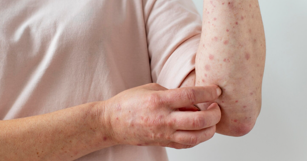 ВОЗ официально объявила Кабо-Верде, Маврикий и ...