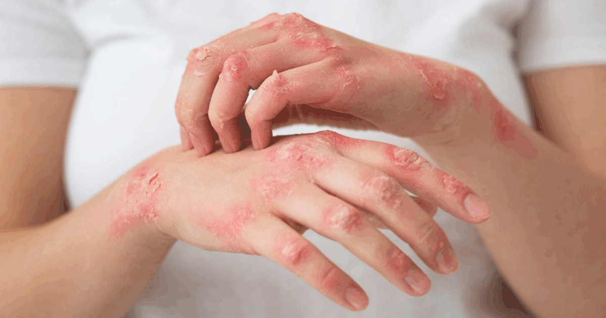 Исследование в журнале Dermatitis показало связ...