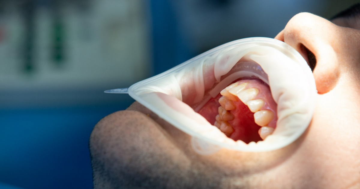 В БФУ разработали микроигольчатые пластыри из м...