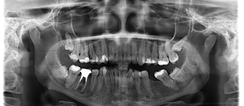 Без прикрас. Самарский врач рассказал всю правду об имплантации зубов.
